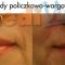 Kwas hialuronowy: Saypha, Restylane, Juvederm, Stylage