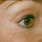 Dermal fillers