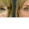 Eyelid surgery (Blepharoplasty)