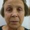 Facelift