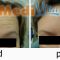 Botulinum toxin - Wrinkle Removal