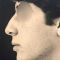 Rhinoplastie