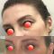 Blépharoplastie