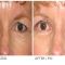 Eyelid surgery (Blepharoplasty)