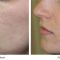 Laser acne treatment