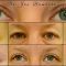 Operácia očných viečok (Blepharoplastika)