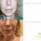 Facelift, SMAS facelifting