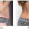 Laserová liposukce - SlimLipo