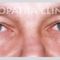 Eyelid surgery (Blepharoplasty)