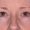Ultherapy