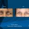 Operácia očných viečok (Blepharoplastika)