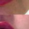 Kwas hialuronowy: Saypha, Restylane, Juvederm, Stylage