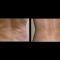 Laserová liposukce - SlimLipo