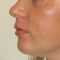 Hyaluronic acid-based wrinkle fillers