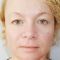 Operácia očných viečok (Blepharoplastika)