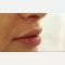 Lip augmentation - cheiloplasty