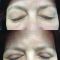 Operácia očných viečok (Blepharoplastika)