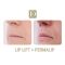 Augmentation des lèvres par Permalip