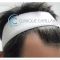 Greffe de cheveux