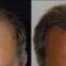 Greffe de cheveux