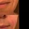 Filler antirughe a base di acido ialuronico