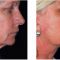 Lifting du visage