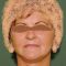 Facelift, SMAS Facelift