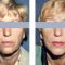 Facelift