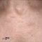 Peeling chemiczny
