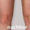 Liposuktion - Fettabsaugung