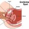 Augmentation du point G