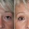 Eyelid surgery (Blepharoplasty)