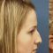 Rhinoplasty (Nose Job)