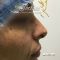 Rhinoplastie