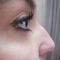 Rhinoplastie médicale