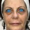 Injections d