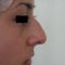 Operácia nosa (Rhinoplastika)