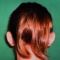 Ear surgery (Otoplasty)