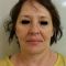 Facelift, SMAS Facelift