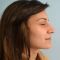 Operácia nosa (Rhinoplastika)