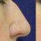Rinoplastika (operacija nosa)