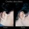 Otoplastie (Chirurgie esthétique des oreilles)