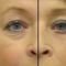 Teosyal, Restylane, Esthelis, Juverdem, Surgiderm (preparáty kyseliny hyaluronovej)