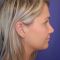 Plastika nosu (Rhinoplastika)