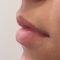 Lip augmentation - cheiloplasty