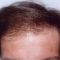 Trapianto capelli
