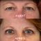 Blépharoplastie