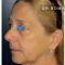 Lifting du visage