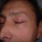 Blépharoplastie inférieure