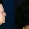 Forehead lift (Brow lift)